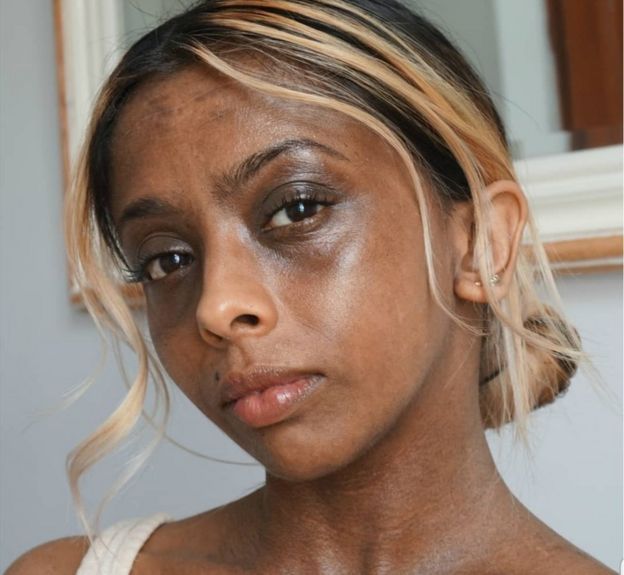 كاريشما كانت تفرك جلدها اثناء الاستحمام على أمل تغيير لون بشرتها وتسببت هذه المنتجات بتفاقم الاكزيما التي تعاني منها