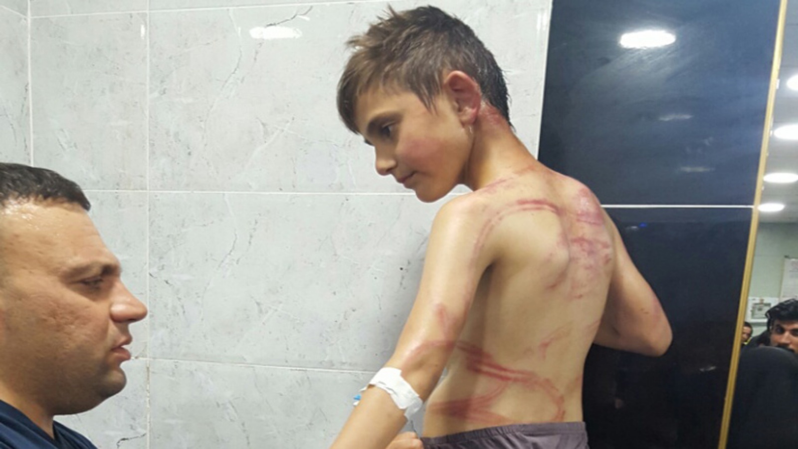 طفل عراقي يعالج من اصابات في عنف منزلي