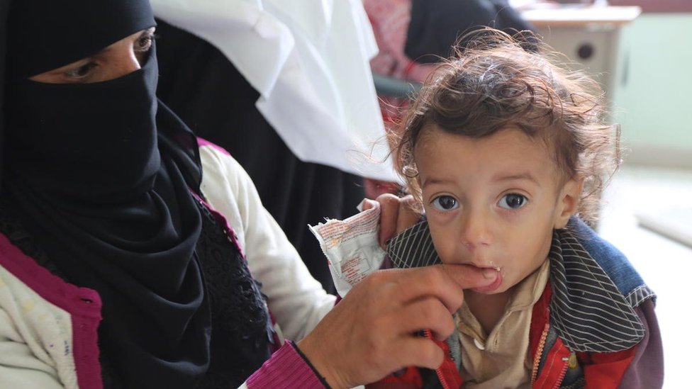 طفل بعمر 14 شهرا يعاني من سوء التغذية يتلقى علاجا في عياردة مدينة عمران باليمن Mohammed Awadh/ Save the Children