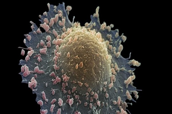 خلايا سرطان الرئتين تتجول بحرية في الجسم
