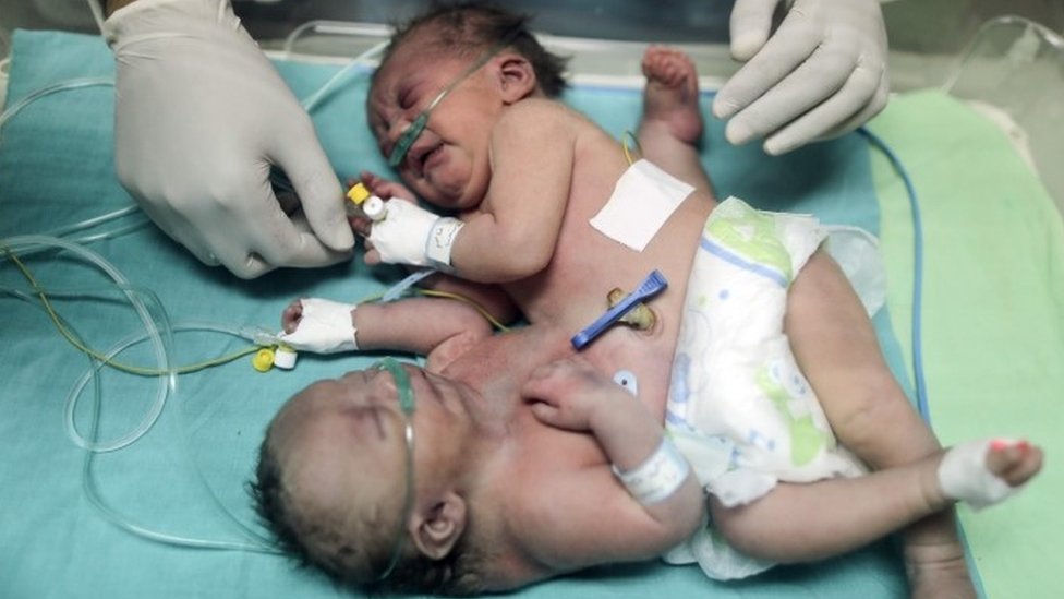 أطباء يدعون لإنقاذ حياة توأم ملتصق في قطاع غزة