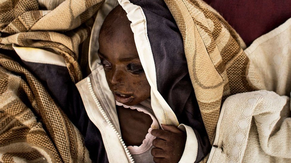 مئات الآلاف من الأطفال الذين يعانون من سوء التغذية يواجهون خطر المجاعة