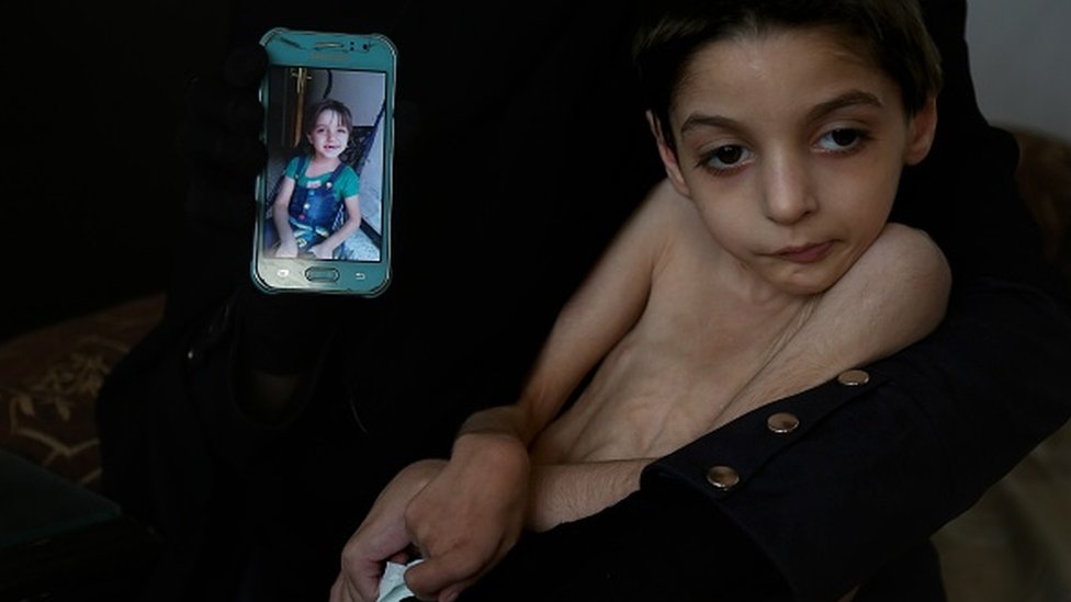 طفلة تعاني سوء التغذية في الغوطة