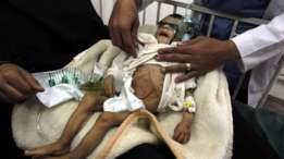 الغارديان: المجتمع الدولي سيواجه وضعا إنسانيا مأساويا في اليمن