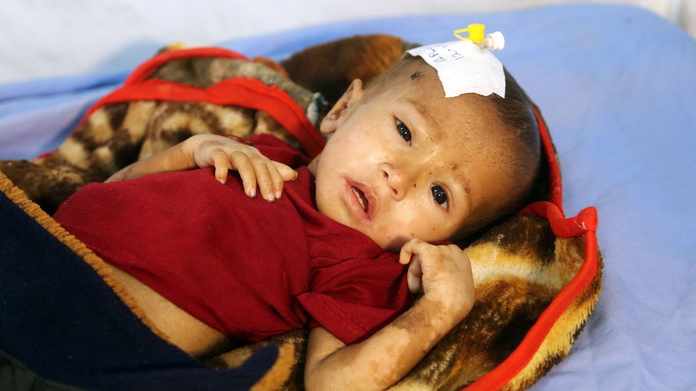 يعاني نحو مليون طفل دون سن الخامسة من سوء تغذية في اليمن