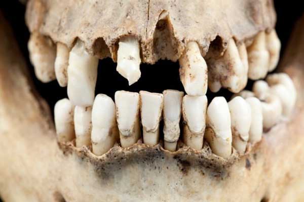 آفات الأسنان هي نفسها منذ الإنسان البدائي