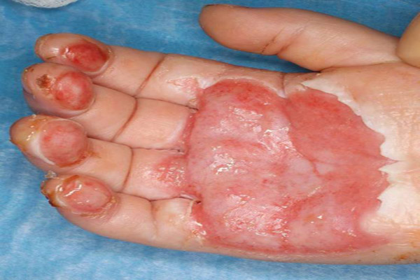 آثار حروق ناتجة من تعذيب الأطفال في ألمانيا