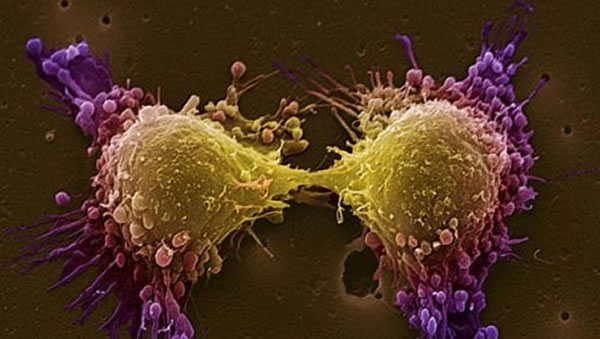 خلية سرطان البروستاتا