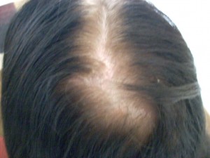 تساقط الشعر لدى النساء أسبابه كثيرة