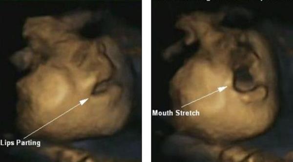 صورة ثلاثية الأبعاد تظهر حركة الشفاه للجنين