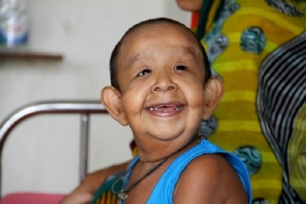 مرض غامض يصيب طفلا في بنغلادش ويجعله أشبه بالمسنين