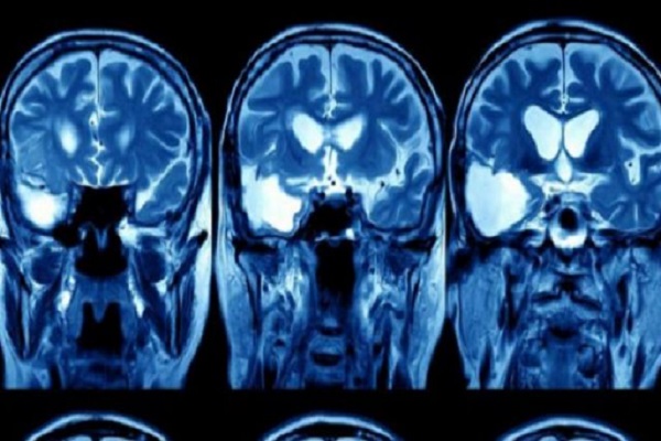 استخدام نظام الذكاء الصناعي لغوغل في علاج سرطان الرأس والعنق