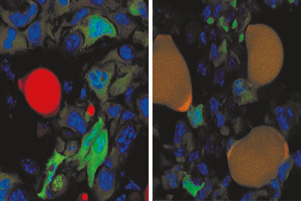 خلايا سرطانية (اللون الأخضر) تحولت بالعلاج إلى خلايا دهنية (باللون البني)