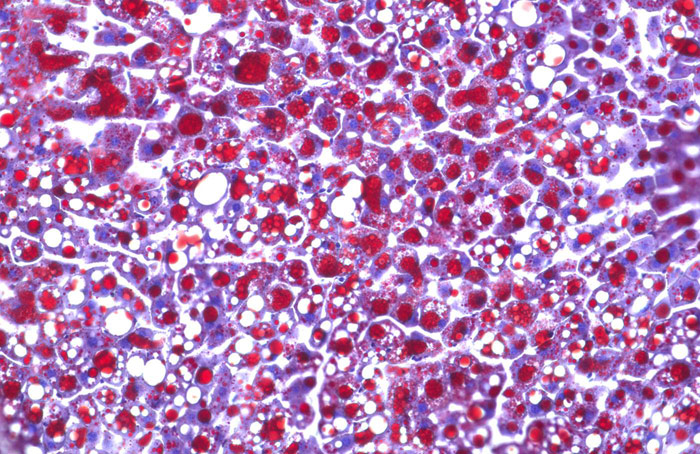 الصورة من معهد هيلمهولتز: خلايا كبد الفأر المتشحمة بفعل الكورتيزون تحت المجهر