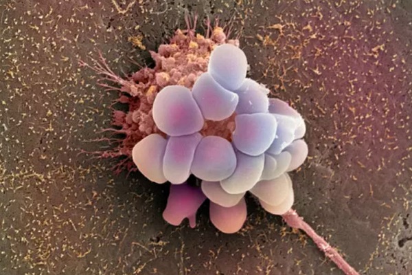 قلة البكتيريا المفيدة تزيد خطر تعرض النساء لسرطان المبيض