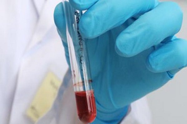 اختبار دم يتكهن بخطر الوفاة خلال السنوات العشر القادمة !
