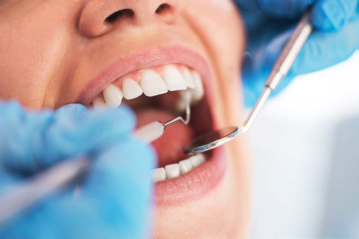 دراسة تشير إلى امكانية إعادة نمو طبقة مينا الأسنان دون استخدام الحشوات