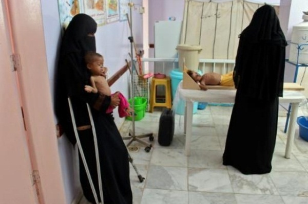 طفل يعاني من سوء تغذية يعالج في مستشفى في شمال غرب اليمن