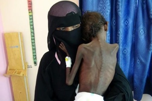 مستشفى يمني يكافح لمعالجة سوء التغذية لدى أطفال مع كثرة الحالات