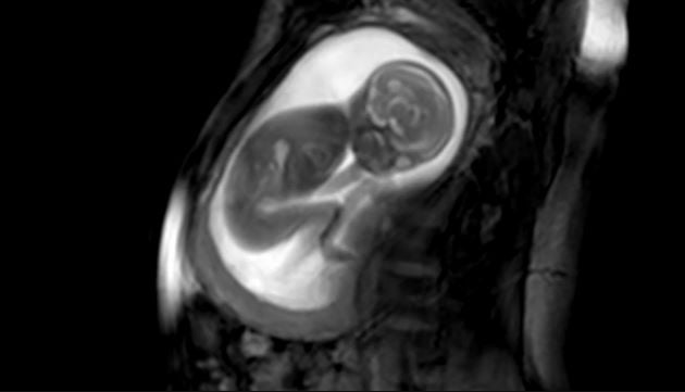 صور ثلاثية الأبعاد لقلب الجنين في رحم أمه