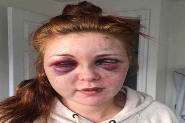 الضحية جينا هيرلي بعد تشويه وجهها