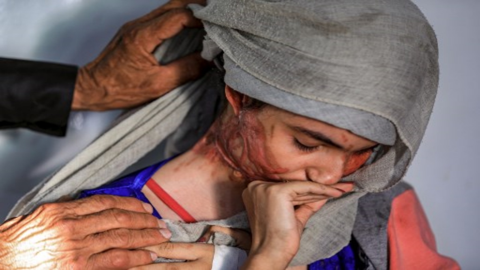 العنود حسين شريان ، فتاة تبلغ من العمر 19 عامًا تعرضت للتشوه في هجوم بالحامض من قبل زوجها الذي أساء معاملتها ، تجلس في مستشفى حيث تخضع للعلاج في العاصمة اليمنية صنعاء في 28 يناير 2021 حيث تخلع حجابها لتظهر إصاباتها