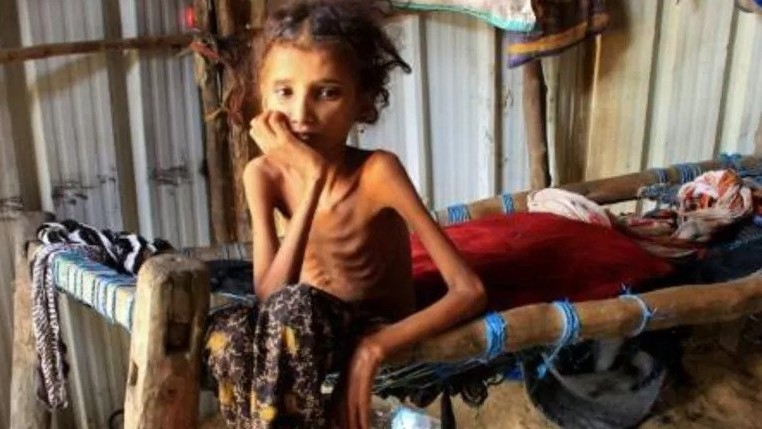 طفلة يمنية تبلغ 10 سنوات وتعاني من سوء التغذية الحاد في حجة بتاريخ 23 يناير 2021