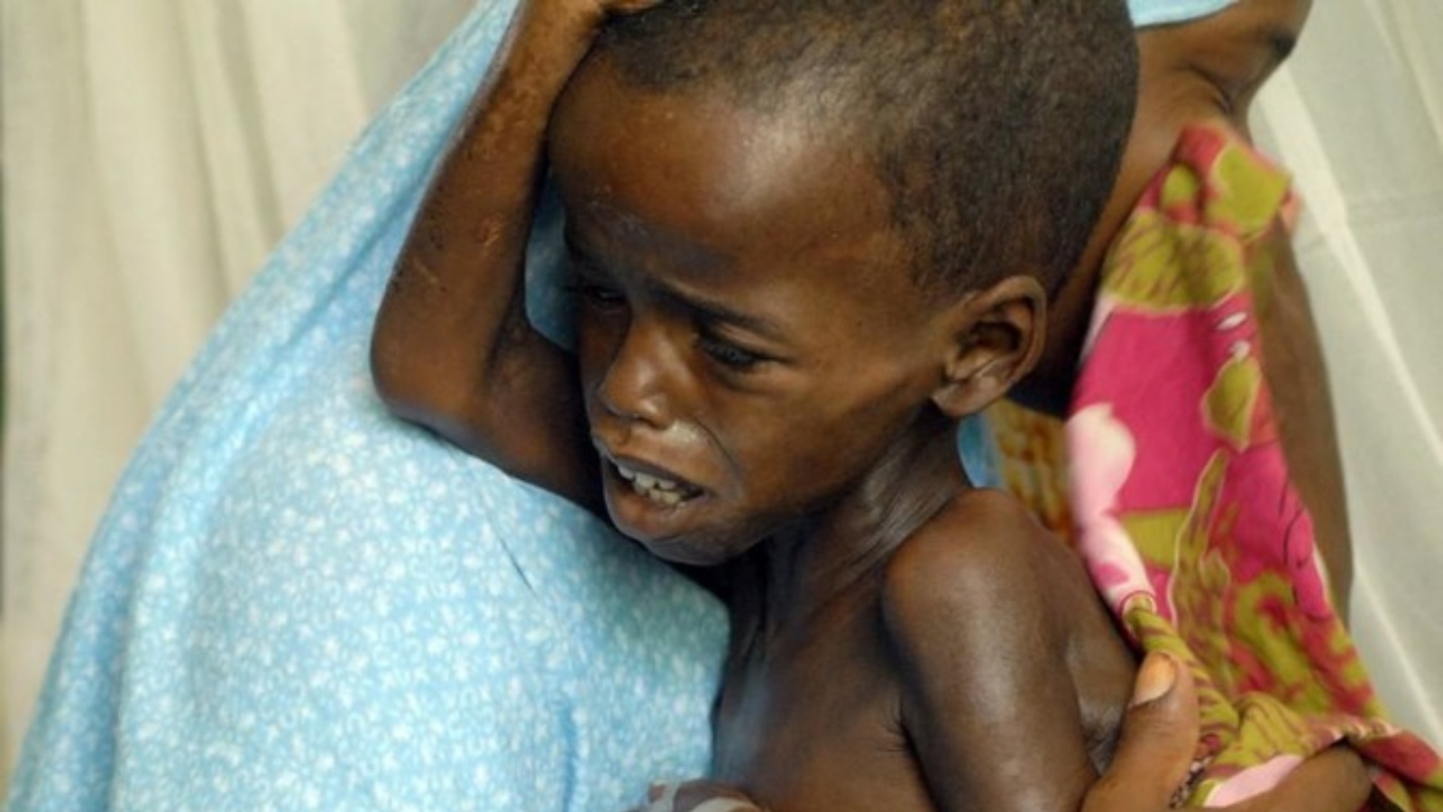 طفل يعاني من سوء التغذية الحاد ينتظر مع والدته ليتم إدخاله إلى مستشفى بنادير في العاصمة الصومالية مقديشو.