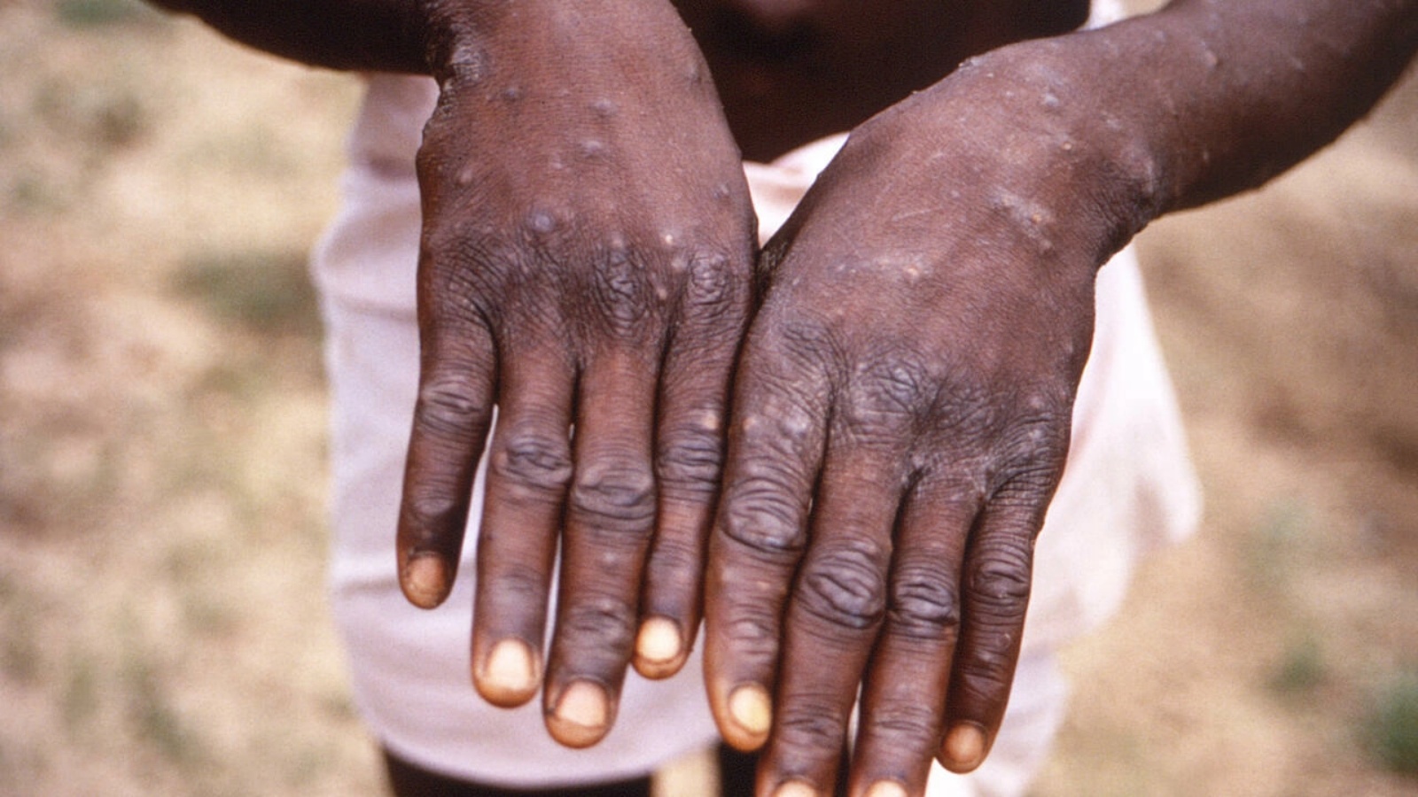طفح جلدي على يدي رجل أصيب بجدري القردة في جمهورية الكونغو الديموقراطية في 1997 في صورة وزّعتها المراكز الأميركية للسيطرة على الأمراض والوقاية منها.