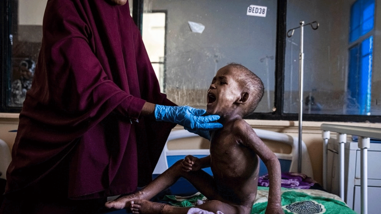 علي عبد الله محمد، صبي يبلغ من العمر 27 شهراً يعاني من سوء التغذية الحاد، يتم فحصه من قبل ممرضة لتلقي العلاج في مستشفى بنادير للولادة والأطفال في مقديشو، الصومال. 1 حزيران\يونيو 2022.