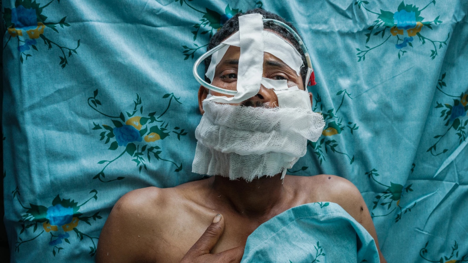 مقاتل من جبهة تحرير تيغراي الشعبية أصيب برصاصة في خده بعد الجراحة في مستشفى آيدر التخصصي الشامل في ميكيلي، عاصمة منطقة تيغراي الإثيوبية