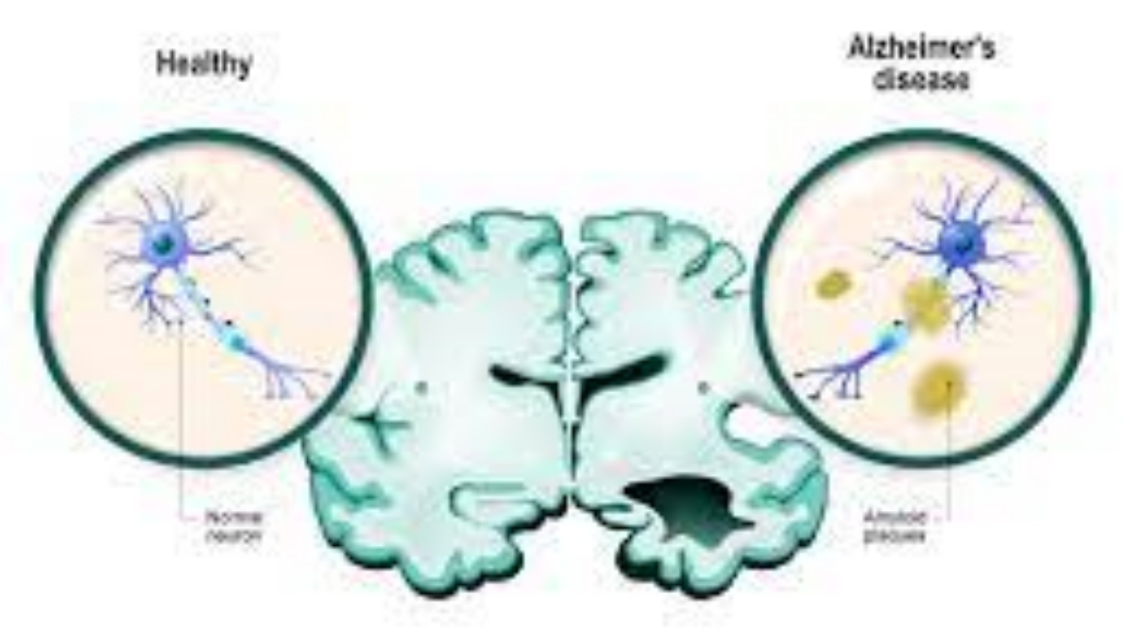 رسم إيضاحي لعملية إبطاء العقار الجديد للألزهايمر 