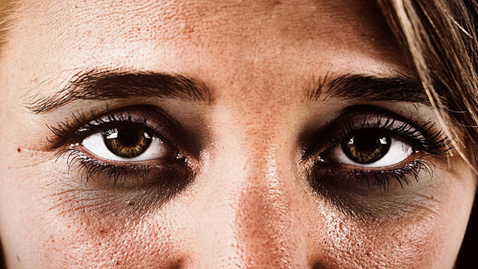 صورة توضيحية للهالات السود تحت العيون