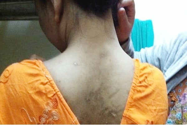 صورة لخادمة تعرضت للتعذيب نشرتها امنيستي على موقعها