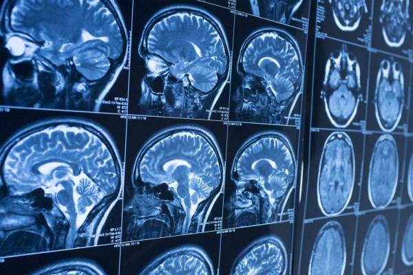 دراسة جديدة: وجود علاقة بين تكوين الدماغ والذكاء