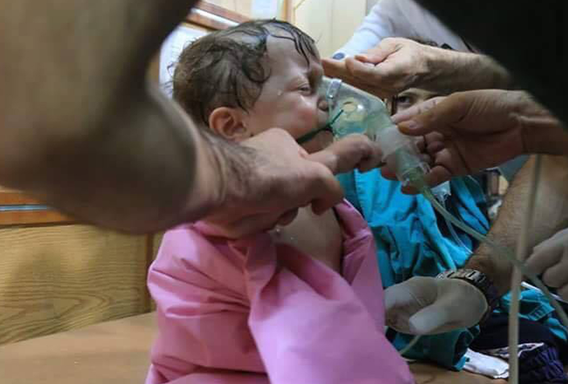 ولادة طفل سوري مشوه بعد استنشاق والدته غازا كيميائيا
