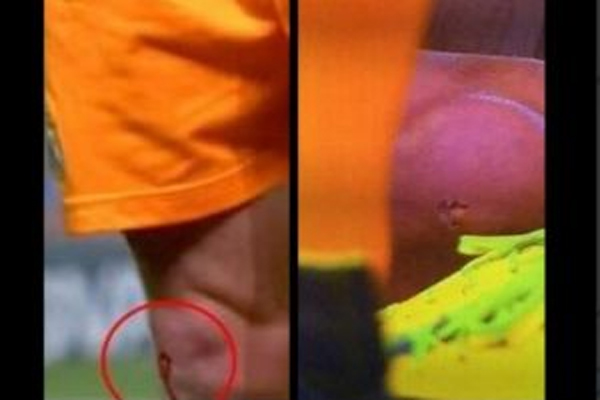 صورة للجرح في ركبة غاريث بيل