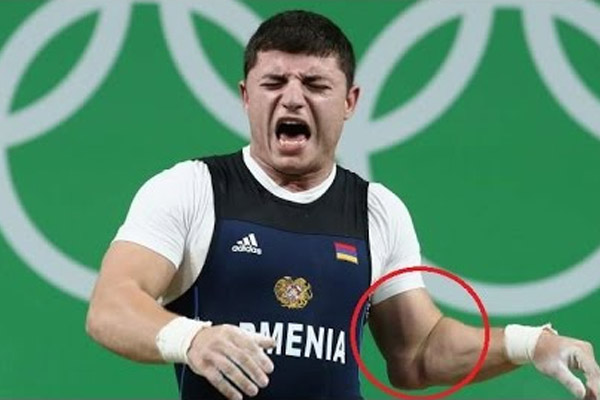 نقل الرباع الارميني اندرانيك قربيتيان الى المستشفى للعلاج بعد تعرضه لاصابة خطرة في الكوع