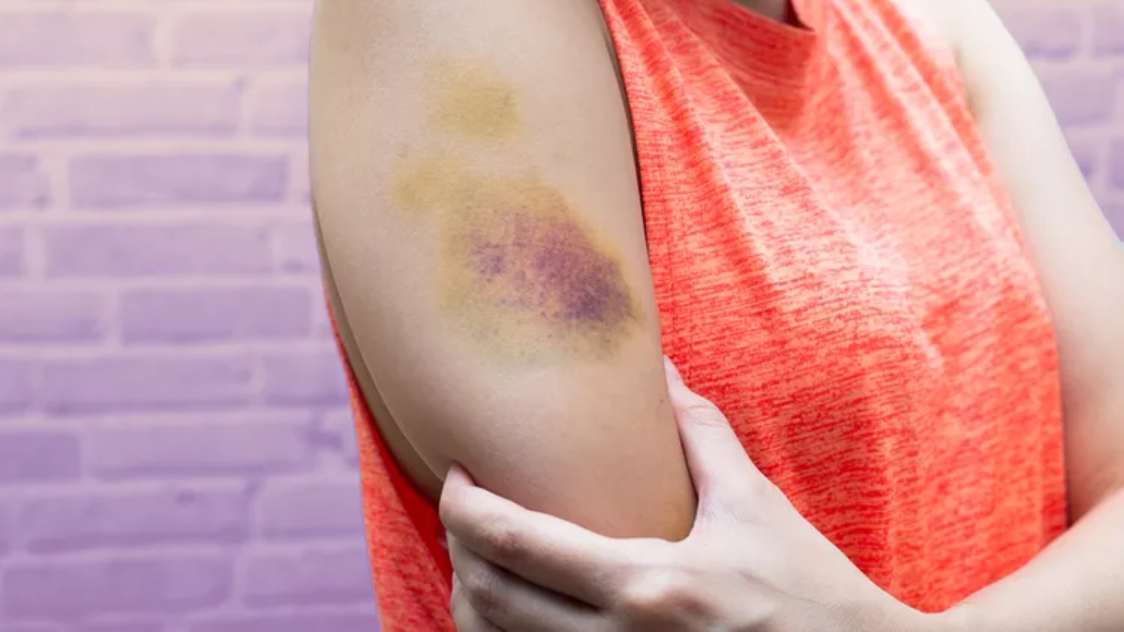 تحدث الكدمات عند احتباس الدم أسفل الجلد