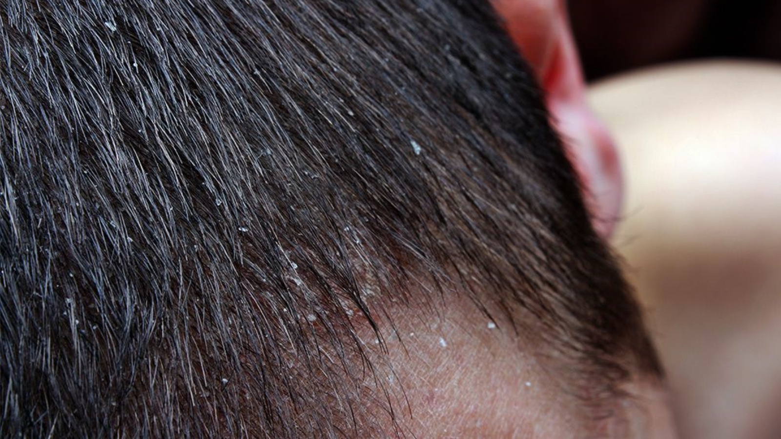 عادة ما ترتبط القشرة بفروة الرأس الدهنية