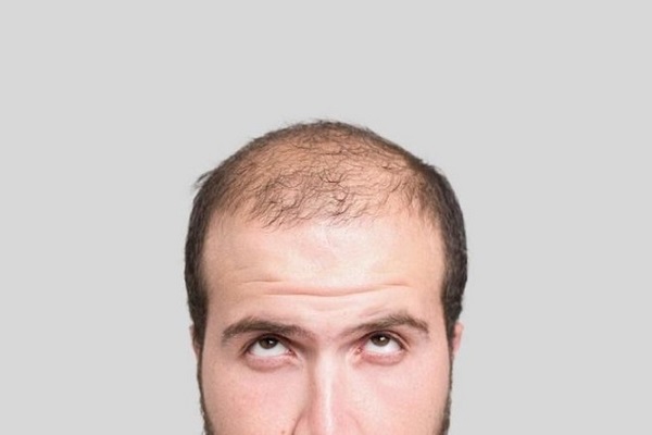 اكتشاف قد يغني عن عمليات زرع الشعر
