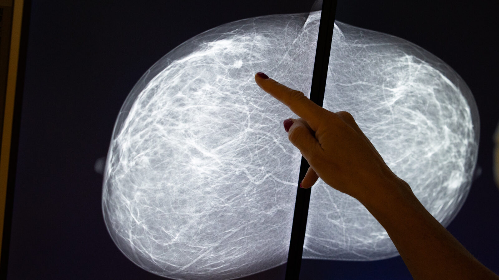 عرض صورة ماموغرام في عيادة لأمراض الثدي في بروكسل. كثافة الثدي هي عامل خطر معروف للإصابة بسرطان الثدي.