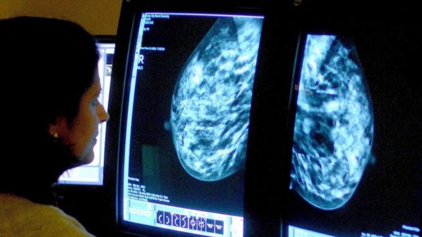 طبيبة أورام تعاين نتيجة صورة الرنين المغنطيسي لإحدى مريضات سرطان الثدي. (عن صفحة DigniCap Europe في تويتر).