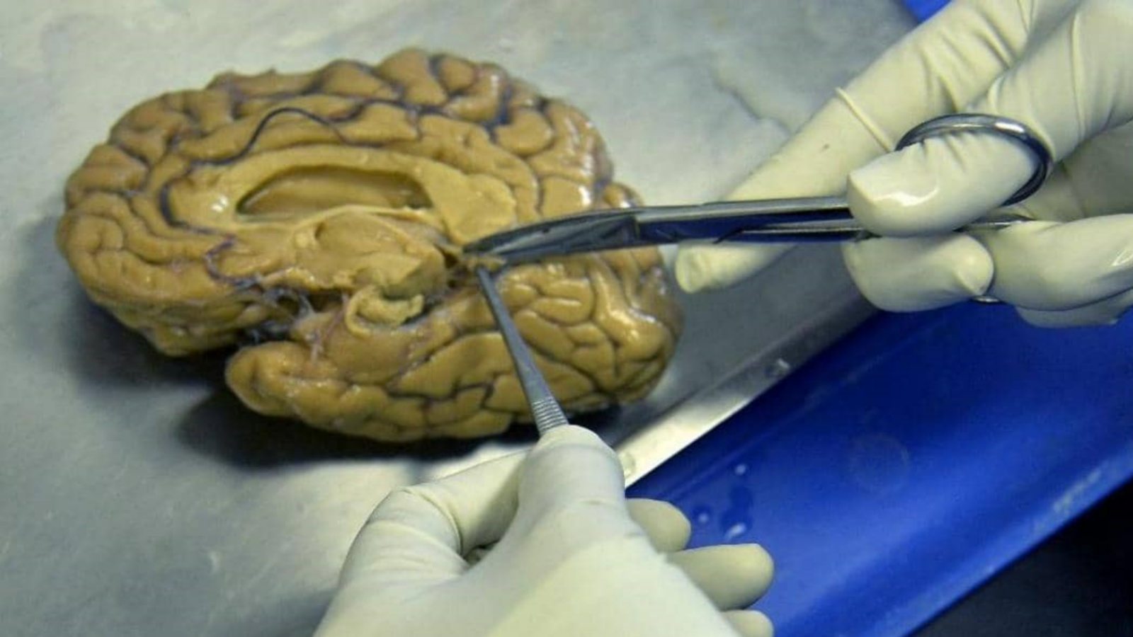 عملية تشريح الدماغ في المختبر. (أرشيفية)