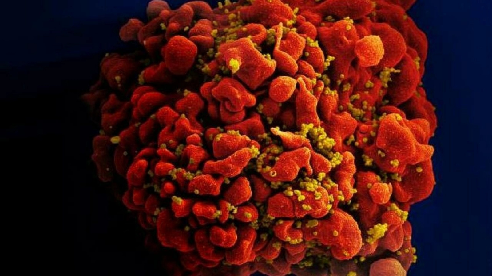 خلايا دم بيضاء بشرية مصابة بفيروس نقص المناعة البشرية (توضيحية)
