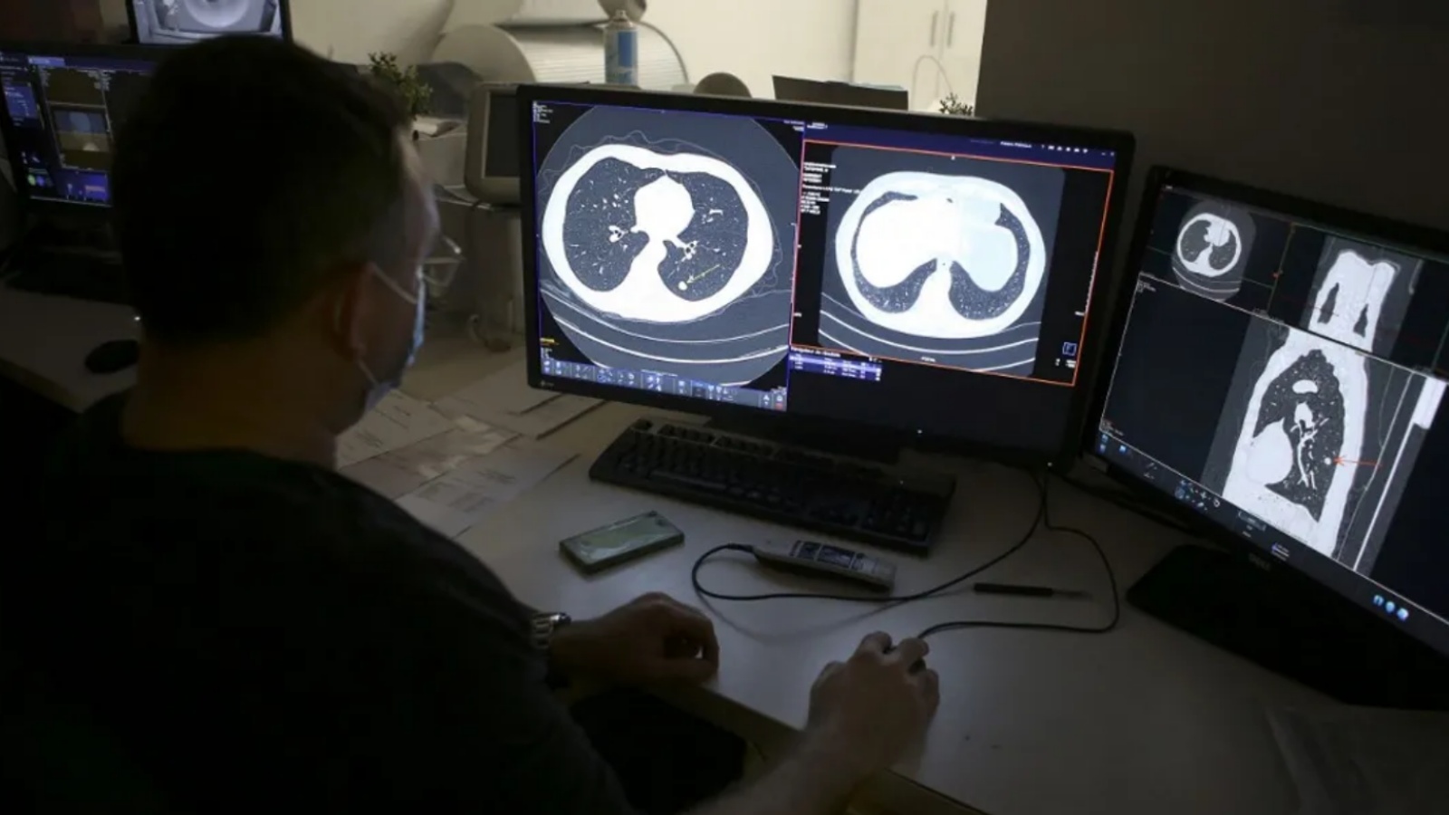 طبيب يعاين صوراً لرئة مريض بالسرطان (توضيحية)