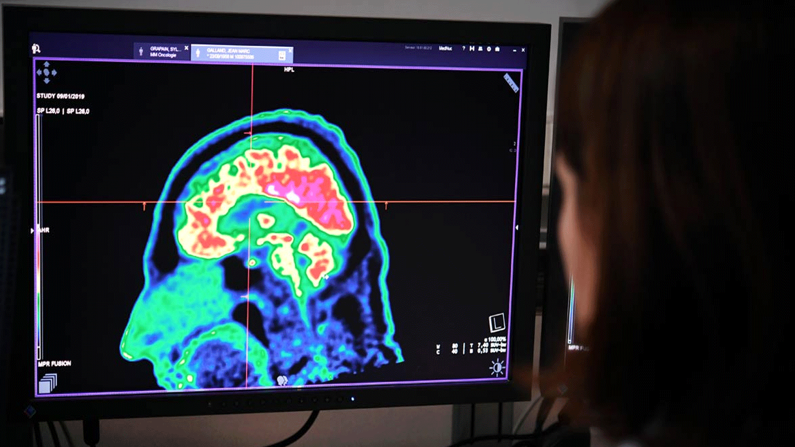 يُنظر إلى مسح لدماغ بشري تم التقاطه بواسطة ماسح التصوير المقطعي بالإصدار البوزيتروني (PET)، على شاشة في مركز المستشفى الإقليمي والجامعي في بريست في غرب فرنسا.