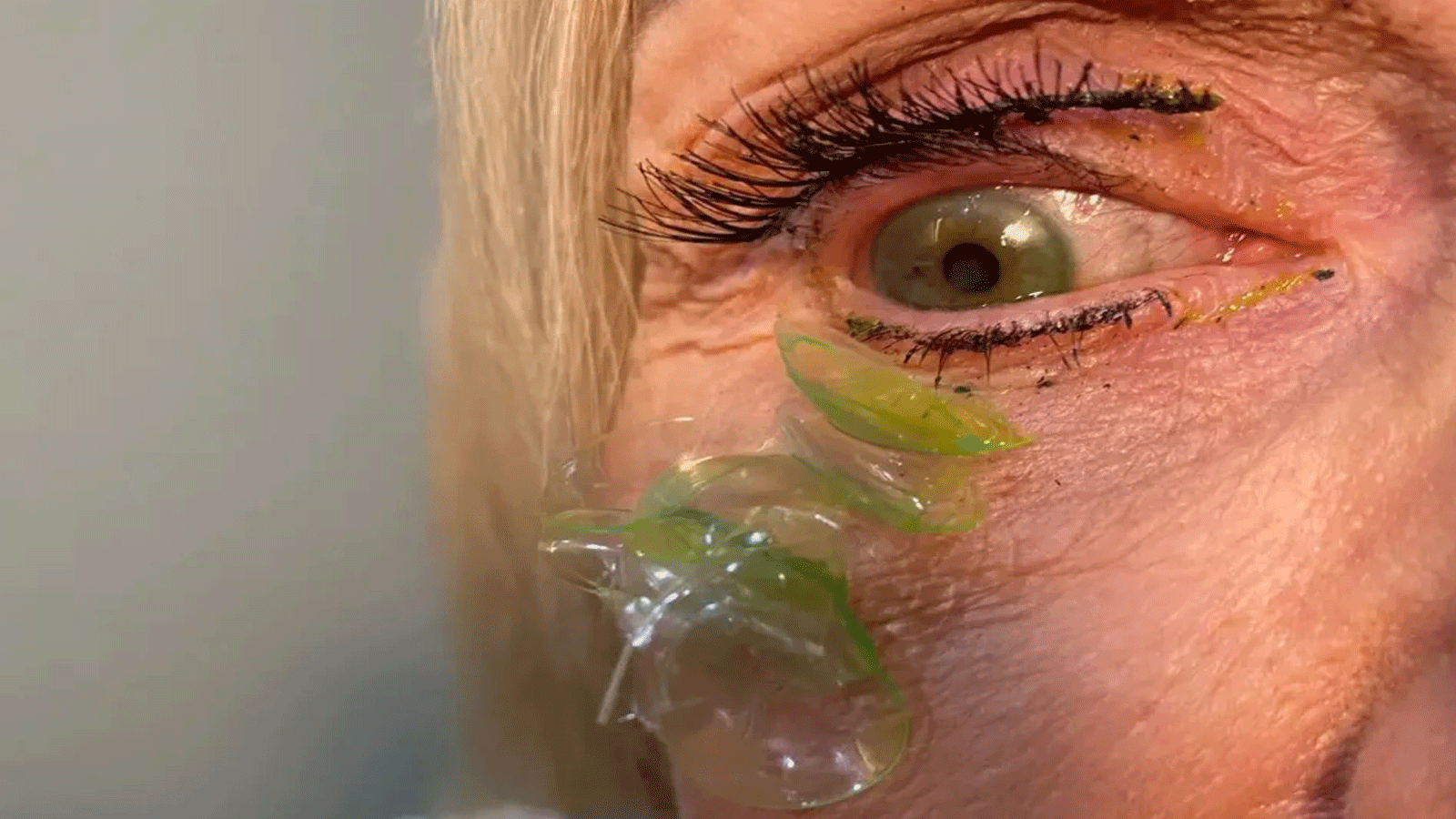 عين المريضة كانت تحمل 23 عدسة لاصقة بعد أن نسيت إخراجها قبل النوم. (المصدر: الدكتورة كاترينا كورتيفا)