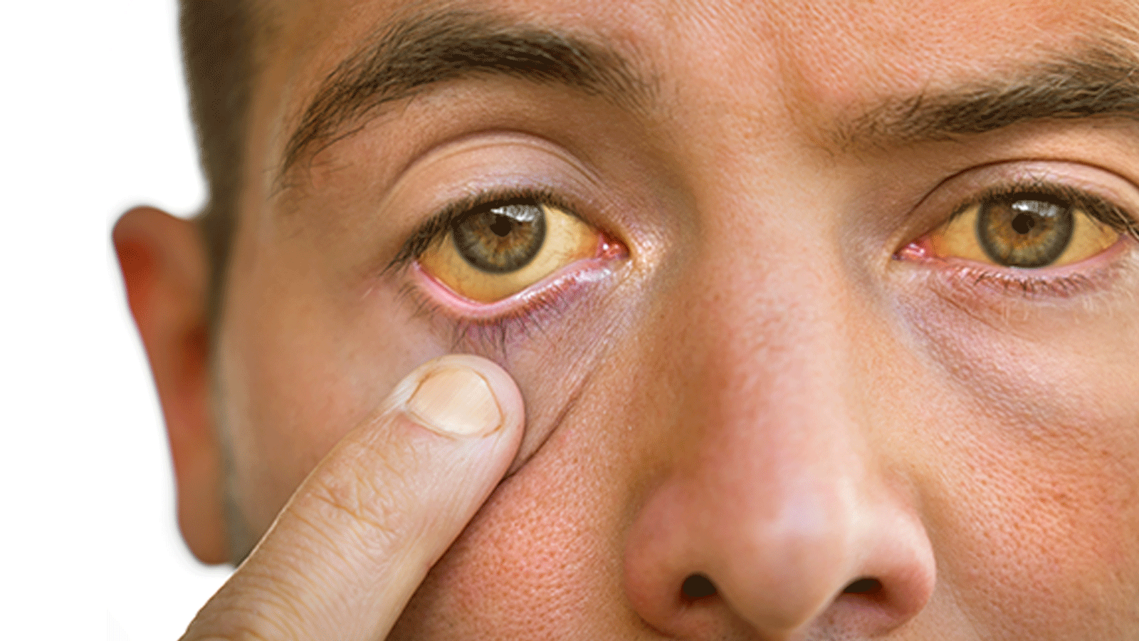 اصفرار العين دليل على وجود خطب ما(center for sight)