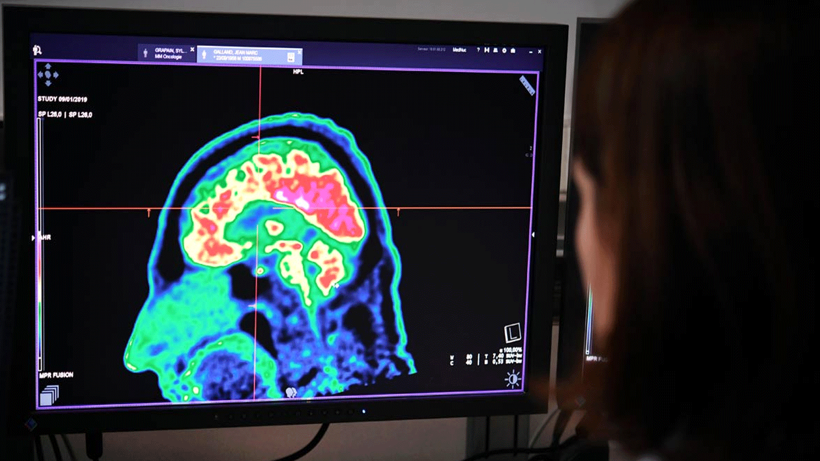 طبيبة تراقب حالة دماغ مصاب بورمٍ سرطاني